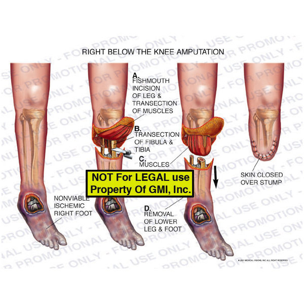 The exhibit illustrates an amputation right below the knee showing fishmouth incision of leg and transection of muscles, transection of fibula and tibia, muscles, removal of lower leg and foot, and skin closed over stump.