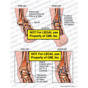 Leg or Ankle Injury or Hardware