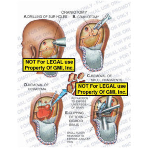 Brain: Craniotomy or Cranioplasty