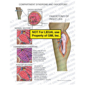 The exhibit illustrates compartment syndrome and fasciotomy of the right leg with a cross section view showing swelling of leg inside fascial compartments compressing blood vessels and reducing blood supply to leg, and release of fascia allowing compartments to eliminate the compression of blood vessels and re-establish blood supply to leg.