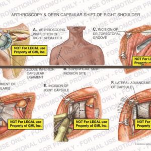 The exhibit illustrates arthroscopy and open capsular shift of right shoulder showing arthroscopic inspection of right shoulder, superficial skin incision site, incision of deltopectoral groove, detachment of subscapularis tendon, incision of joint capsule, and lateral advancement of capsule.