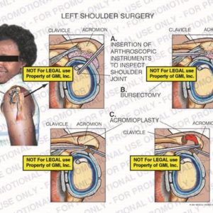 The exhibit illustrates left shoulder surgery showing insertion of arthroscopic instruments to inspect shoulder joint, bursectomy and acromioplasty.