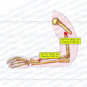 Forearm/ Wrist Injuries or Hardware