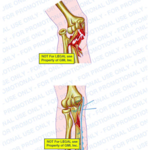The exhibit illustrates pre-op and post-op conditions of the right elbow showing dislocation of radius, comminuted fracture dislocation of ulna, relocation of radius, and plates and screws fixating comminuted fracture dislocation of ulna.
