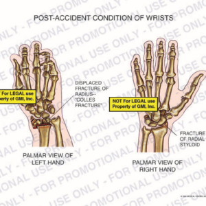 The exhibit illustrates post-accident conditions of wrists with palmar views of left and right wrists showing displaced fracture of radius, i.e., "colles fracture", as well as fracture of radial styloid.
