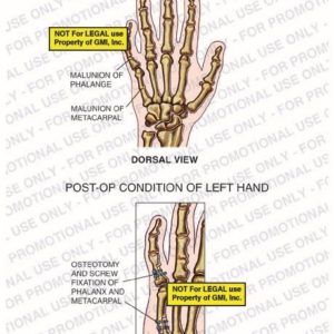 The exhibit illustrates pre-op and post-op conditions of left hand with a dorsal view showing malunion of phalange and metacarpal, and osteotomy and screw fixation of phalanx and metacarpal.