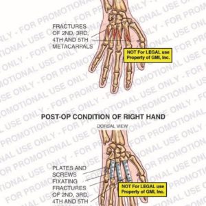 The exhibit illustrates pre-op and post-op conditions of right hand with dorsal views showing fractures of 2nd, 3rd, 4th and 5th metacarpals and plates and screws fixating fractures of 2nd, 3rd, 4th and 5th metacarpals.