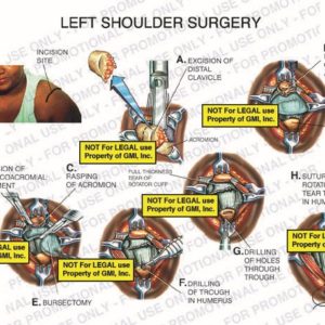 The exhibit illustrates left shoulder surgery due to rotator cuff injury showing excision of distal clavicle, end of acromion, and coracoacromial ligament, rasping of acromion, bursectomy, drilling into humerus, and suturing of rotator cuff tear.