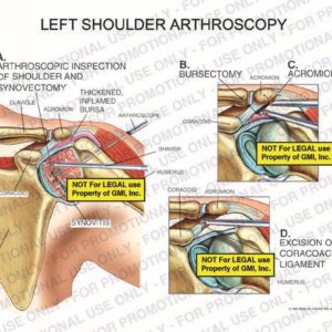 The exhibit illustrates left shoulder arthroscopy showing arthroscopic inspection of shoulder and synovectomy, bursectomy, acromioplasty, and excision of coracoacromial ligament.