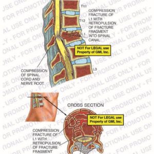 The exhibit illustrates the pre-op condition of the spine with, sagittal and cross section views, showing a compression fracture of L1 with retropulsion of fracture fragment into the spinal canal and compression of the spinal cord and nerve root.