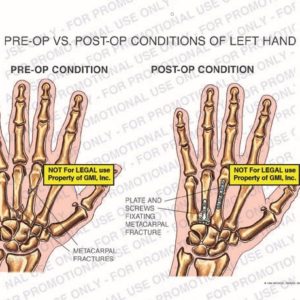 The exhibit illustrates pre-op vs.post-op conditions of left hand showing metacarpal fractures in pre-op condition and plate and screws fixating metacarpal fracture in post-op condition.