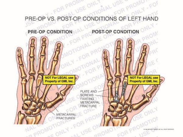 The exhibit illustrates pre-op vs.post-op conditions of left hand showing metacarpal fractures in pre-op condition and plate and screws fixating metacarpal fracture in post-op condition.