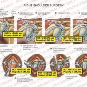 The exhibit depicts biceps, rotator cuff and labral tears, debridement of rotator cuff, biceps tendon and labrum, acromioplasty, coracoacromial ligament release. open shoulder incision with incision of deltoid muscle, roughening of greater tuberosity of the humerus, debridement of torn rotator cuff and suture repairs of the rotator cuff.