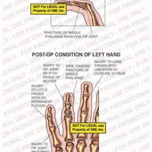 The exhibit illustrates pre-op condition and post-op conditions of left finger and hand showing fracture of middle phalange involving pip joint, left ring hand with injury to PIP (proximal interphalangeal) joint requiring future fusion, injury to little finger with 15Y permanent flexion, injury to DIP (distal interphalangeal) joint with 10Y range of motion, wire fixating fractures of middle phalange, and injury to long finger with limitation of closure to palm.