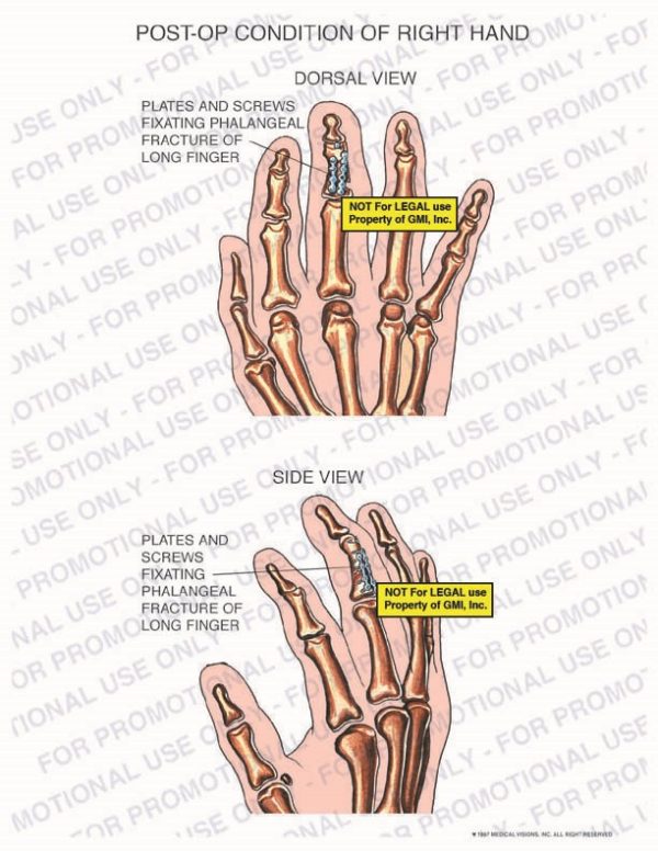 The exhibit illustrates the post-op condition of right hand with dorsal and side views showing  plates and screws fixating phalangeal fracture of long finger.