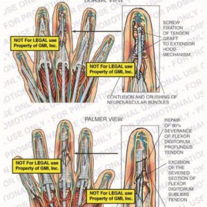 The exhibit illustrates the post-op condition of right hand with dorsal and palmer views showing contusion and crushing of neurovascular bundles, screw fixation of tendon graft to extensor hood mechanism, repair of 80% severance of flexor digitorum profundus tendon, and excision of the severed section of flexor digitorum sublimis tendon.