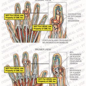 The exhibit illustrates the pre-op condition of the right hand with dorsal and palmer views showing destruction of extensor hood mechanism, contusion and crushing of neurovascular bundles, 80% severance of flexor digitorum profundus tendon, and 50% severance of flexor digitorum sublimis tendon.