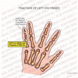The exhibit illustrates the fracture of the middle phalanx of 5th finger on left hand.