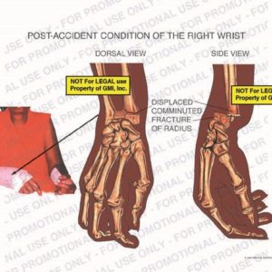 Hand/ Wrist Injuries or Hardware