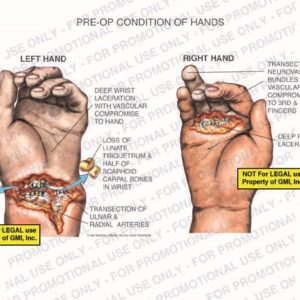 The exhibit illustrates pre-op conditions of the left and right hands showing deep wrist laceration with vascular compromised to hand, loss of lunate, triquetrum and half of scaphoid carpal bones in wrist, transection of ulnar and radial arteries, transection of neurovascular bundles with vascular compromise to 3rd and 4th fingers, and deep palm laceration.