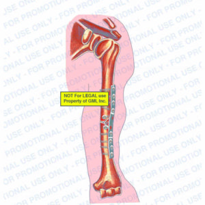 The exhibit illustrates the post-op condition of the left arm with an anterior view showing plate and screws fixating left humerus fracture. 
