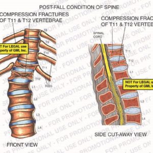 The exhibit illustrates a post-fall condition of spine, with front and side cut-away views, showing compression fractures of T11 and T12 vertebrae, ribs, and spinal cord.