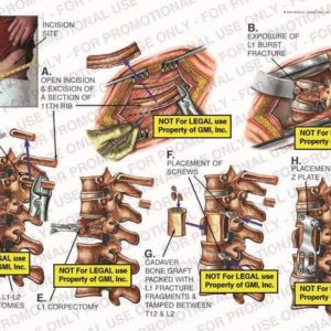 The exhibit illustrates spinal surgery showing incision site, open incision and excision of a section of 11th rib, exposure of L1 burst fracture, excision of head of 12th rib, T12-L1 and L1-L2 discectomies, L1 corpectomy, placement of screws, cadaver bone graft packed with L1 fracture fragments and tamped between T12 and L2, and placement of Z plate.