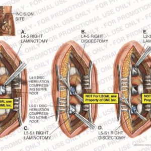 The exhibit illustrates a lumbar discectomy showing incision site, L4-5 right laminotomy and discectomy, L4-5 and L5-S1 disc herniations compressing the nerve roots, L5-S1 right laminotomy and discectomy, and L2-3 right laminotomy.