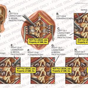 The exhibit illustrates a cervical spine laminotomy, facetectomy, and foraminotomy showing the incision site, left C5-6 laminotomy and medical facetectomy, left C5-6 foraminotomy, nerve root, left C6-7 foraminotomy, right C5-6 laminotomy and medical facetectomy, right C5-6 foraminotomy, right C6-7 laminotomy and medical facetectomy, and right C6-7 foraminotomy.