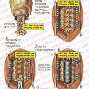The exhibit illustrates a laminectomy and a foraminotomy of the cervical spine showing the incision site, open incision to expose cervical vertabrae, excision of spinous processes, C3- C7 laminectomies and foraminotomies, and dural tube containing spinal cord.