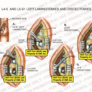 The exhibit illustrates L4-5 and L5-S1 left laminotomies and discectomies of the lumbar spine showing the incision site, L5-S1 left laminotomy, nerve roots, L5-S1 disc herniation, L5-S1 discectomy, L4-5 left laminotomy, L4-5 disc herniation, and L4-5 discectomy.