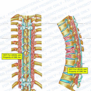 The exhibit illustrates the post-op condition of the thoracic spine, with posterior and lateral views, showing hooks, rods, wires, rib fractures, vertebral body fractures, bone graft, and nerve roots.