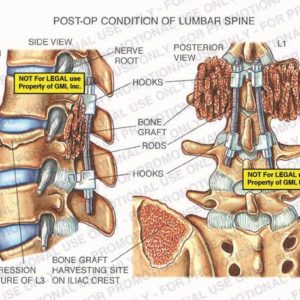 The exhibit illustrates the post-op condition of lumbar spine, with side and posterior views, showing nerve root, compression fracture of L3, bone graft, rods, hooks, and bone graft harvesting site on iliac crest.