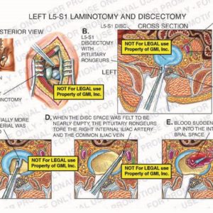 The exhibit illustrates a left L5-S1 laminotomy and discectomy of the lumbar spine, with posterior and cross section views, showing incision site, left laminotomy, L5-S1 disc, L5-S1 discectomy with pituitary rongeurs, removal of disc material, right internal iliac artery, common iliac vein, blood in the intervertebral space, and cauda equina of spinal cord.