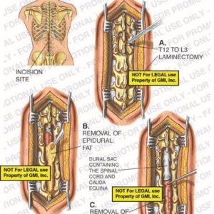 Thoracic, Lumbar, or Sacral Laminectomy or Laminotomy