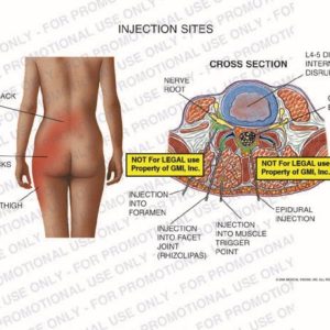 This exhibit illustrates injection sites for low back pain from L4-L5 disc disruption with a cross section view showing transforminal epidural, facet joint, muscle trigger point and interlaminar injections, low back pain radiating into the left buttocks and thigh on the body from the posterior view.
