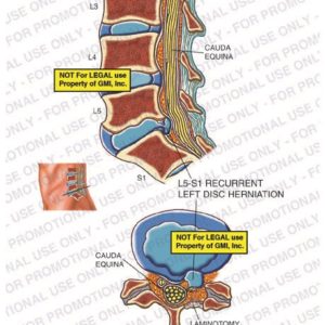 The exhibit illustrates the current condition of the lumbar spine, with sagittal and cross section views, showing cauda equina, L5-S1 recurrent left disc herniation, and laminotomy site.