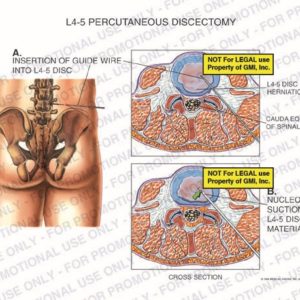 The exhibit illustrates L4-5 percutaneous discectomy of lumbar spine, with cross section views, showing insertion of guide wire into L4-5 disc, L4-5 disc herniation, cauda equina of spinal cord, and nucleotome suctioning L4-5 disc material.