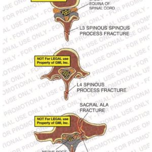 The exhibit illustrates the pre-op condition of spinal fractures, with axial views, showing the cauda equina of spinal cord, L3 and L4 spinous process fractures, sacral ala fracture, and sacral facet joint fracture.