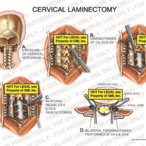 The exhibit illustrates a cervical laminectomy showing incision site on back of neck, exposure of cervical vertabrae, laminectomies of C4 to C6, bilateral medial C4-5 and C5-6 facetectomies, bilateral foraminotomies performed at C4-5 and C5-6, nerve root, and spinal cord.