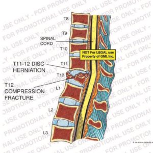 The exhibit illustrates the pre-op condition of a thoracic spine herniation and fracture showing spinal cord, T11-12 disc herniation, and T12 compression fracture.