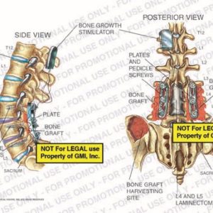 The exhibit illustrates a bone growth stimulator of the spine, with side and posterior views, showing nerve roots, pedicle screws, sacrum, plates, bone graft, bone graft harvesting site, and L4 and L5 laminectomies.