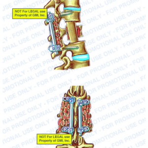 The exhibit illustrates the post-op condition of the spine, with side and posterior views, showing T12 to L2 pedicle screws, rods, and bone graft, T12 to L2 anterior fusion with partial L1 corpectomy, and placement of bone graft.