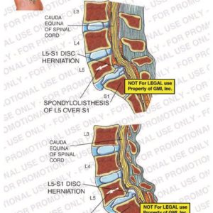 The exhibit illustrates the post-accident pre-op condition of the lumbar spine, showing cauda equina of spinal cord, L5-S1 disc herniation, and spondylolisthesis of L5 over S1 (slipped disc).