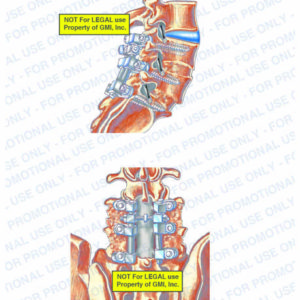 This exhibit illustrates the post-op condition of the spine, with right side and posterior views, showing the posterior and anterior bone graft, rods, pedicle screws, and bone graft harvesting site.