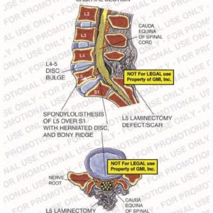 The exhibit illustrates the post-op condition of the lumbar spine, with sagittal and cross section views, showing L4-5 disc bulge, cauda equina of spinal cord, spondylolisthesis of L5 over S1 with herniated disc and bony ridge, L5 laminectomy defect/scar, and nerve root.