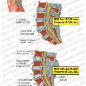 The exhibit illustrates pre-op and post-op conditions of a disc herniation, with a sagittal section view, showing L4-5 disc herniation, L5-S1 disc herniation, cauda equina of spinal cord, recurrent L4-5 disc herniation, and recurrent L5-S1 disc herniation.