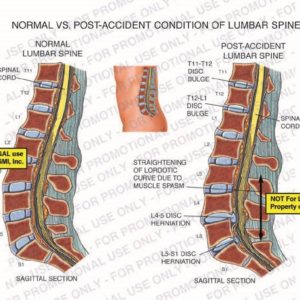 The exhibit illustrates normal vs. post-accident conditions of lumbar spine, with sagittal section views, showing spinal cord, T11-T12 disc bulge, T12-L1 disc bulge, straightening of lordotic curve due to muscle spasm, L4-5 disc herniation, and L5-S1 disc herniation.