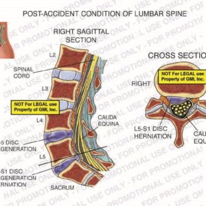 The exhibit illustrates a post-accident condition of the lumbar spine, with right sagittal and cross section views, showing spinal cord, L4-5 disc degeneration, L5-S1 disc degeneration herniation, sacrum, and cauda equina.