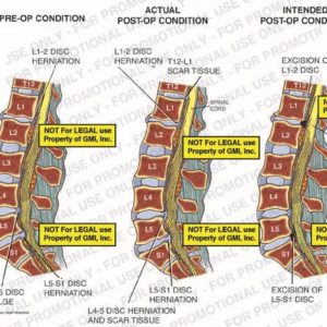 The exhibit illustrates pre-op vs. post-op vs. intended post-op conditions of a disc herniation showing L1-2 disc herniation, L4-5 disc bulge, L5-S1 disc herniation, T12-L1 scar tissue, spinal cord, L4-5 scar tissue, excision of L1-2 disc, and excision of L5-S1 disc.